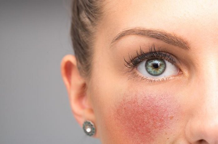 Die Hautkrankheit Rosacea Lasst Sich In Den Griff Kriegen